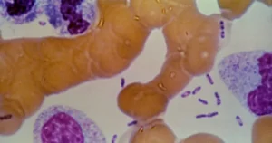 This image appears to be a microscopic view of blood cells, possibly stained for medical analysis, showing various types of cells and possibly bacteria.
