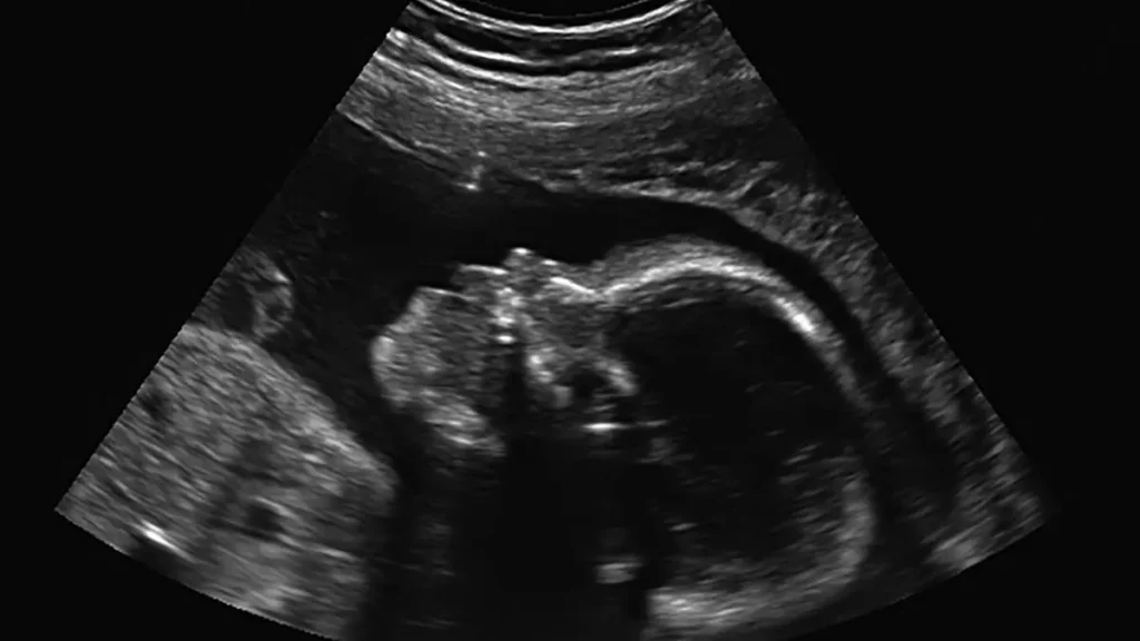 This ultrasound image shows a developing fetus in the womb.
